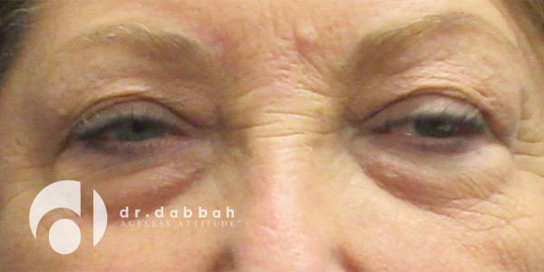 before eyelid surgery front view case 2623 | Dr. Albert Dabbah Boca Raton, FL