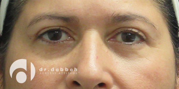 after eyelid surgery front view case 2626 | Dr. Albert Dabbah Boca Raton, FL