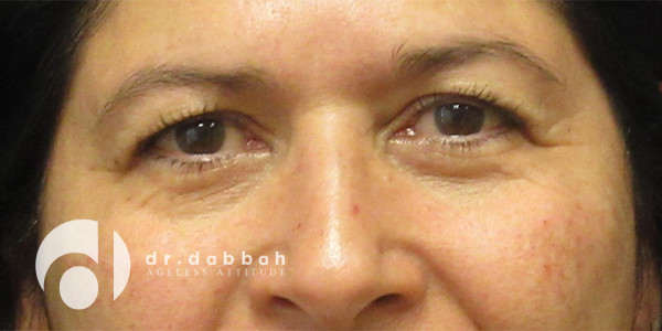 before eyelid surgery front view case 2626 | Dr. Albert Dabbah Boca Raton, FL