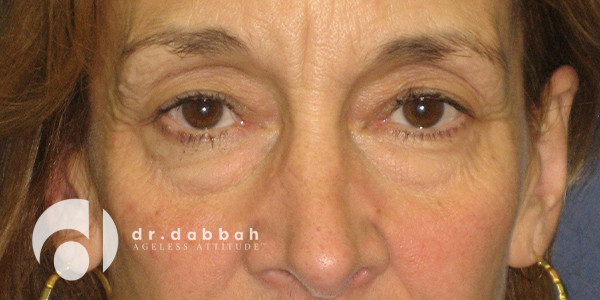 before eyelid surgery front view case 2629 | Dr. Albert Dabbah Boca Raton, FL