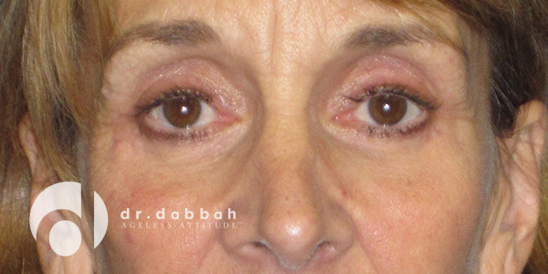 after eyelid surgery front view case 2629 | Dr. Albert Dabbah Boca Raton, FL