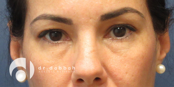 before eyelid surgery front view case 2632 | Dr. Albert Dabbah Boca Raton, FL