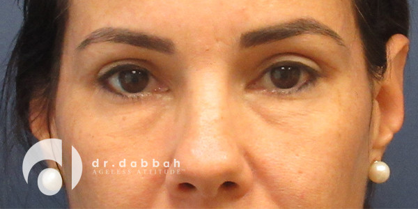 after eyelid surgery front view case 2632 | Dr. Albert Dabbah Boca Raton, FL