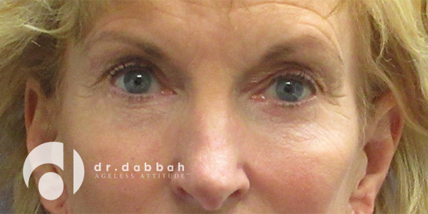 after eyelid surgery front view case 2635 | Dr. Albert Dabbah Boca Raton, FL