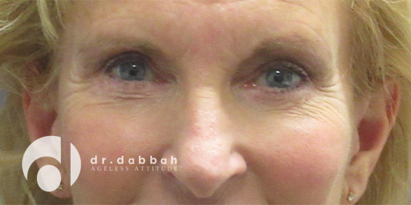 before eyelid surgery front view case 2635 | Dr. Albert Dabbah Boca Raton, FL