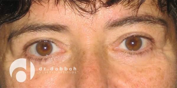 after eyelid surgery front view case 2638 | Dr. Albert Dabbah Boca Raton, FL