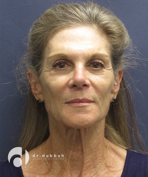 before facelift front view female patient case 2415