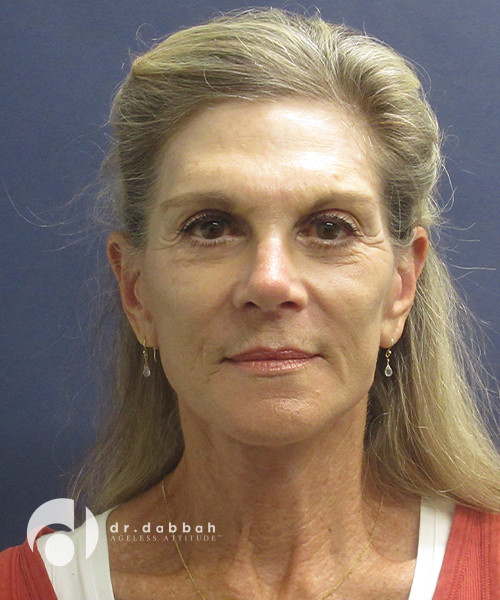 after facelift front side view female patient case 2415