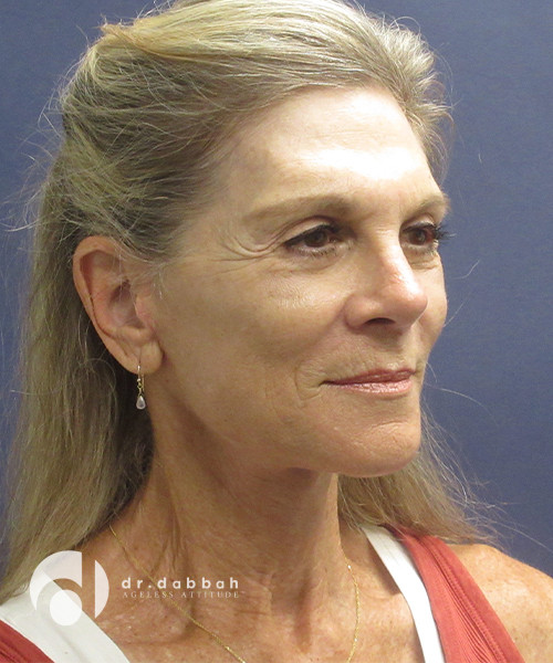 after facelift right view female patient case 2415