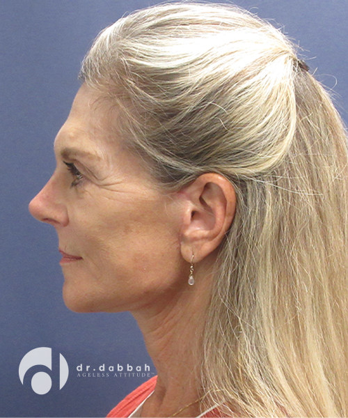 after facelift left side view female patient case 2415