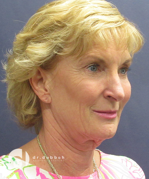 before facelift surgery female patient right angled view case 2437