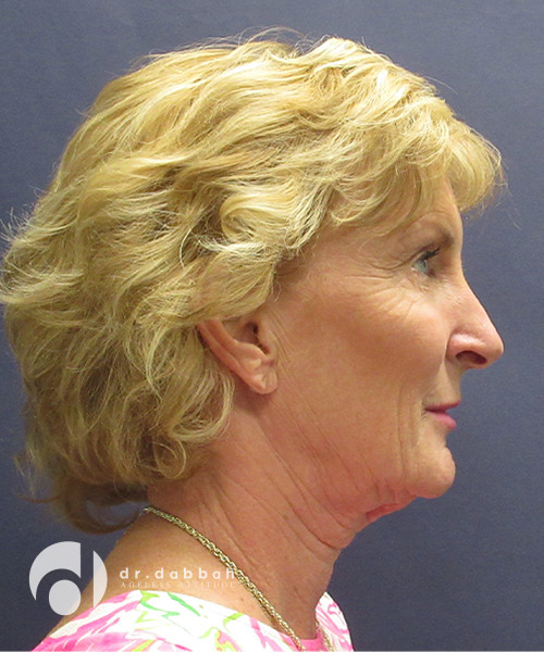 before facelift surgery female patient right side view case 2437