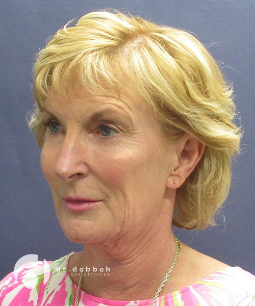 before facelift surgery female patient left angled view case 2437