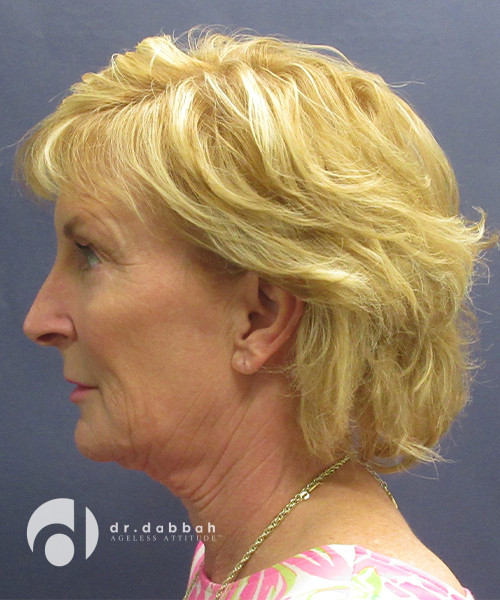 before facelift surgery female patient left side view case 2437