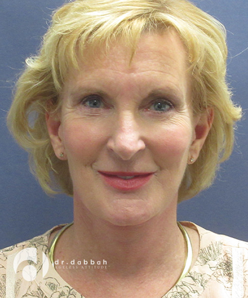 after facelift surgery front view case 2437