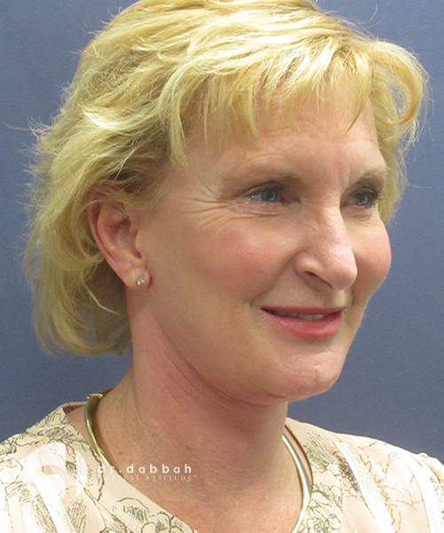 after facelift surgery female patient right angled view case 2437