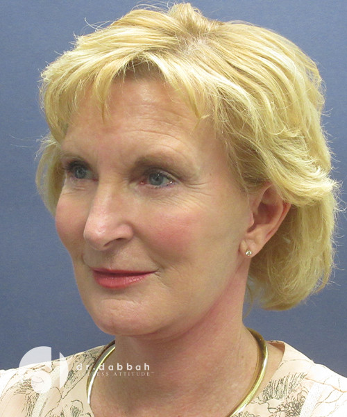 after facelift surgery female patient left angled view case 2437