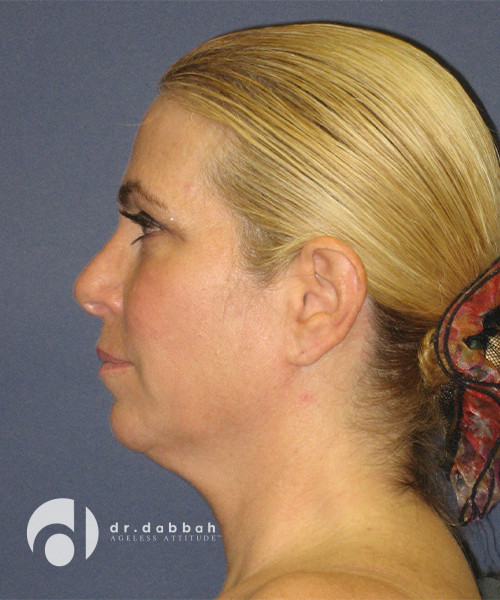 before facelift left side view female patient case 2459