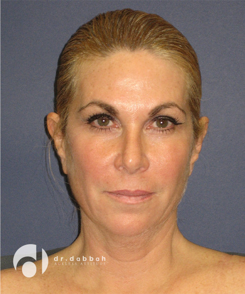 before facelift front view female patient case 2459