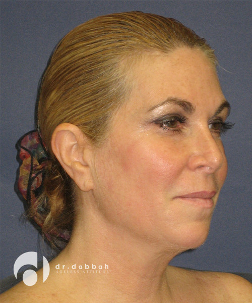 before facelift right view female patient case 2459