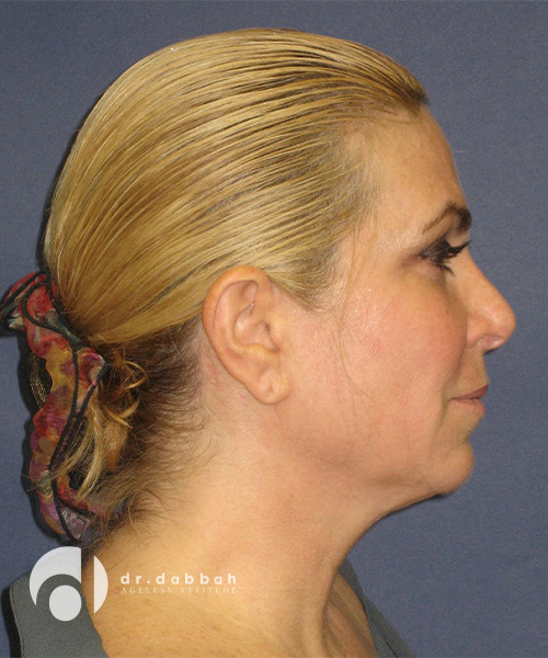 before facelift right side view female patient case 2459