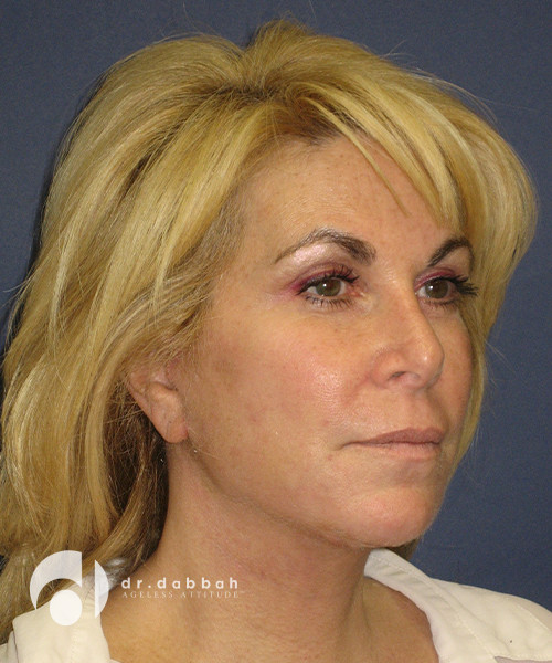 after facelift right view female patient case 2459