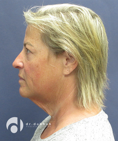 before facelift left side view female patient case 2481