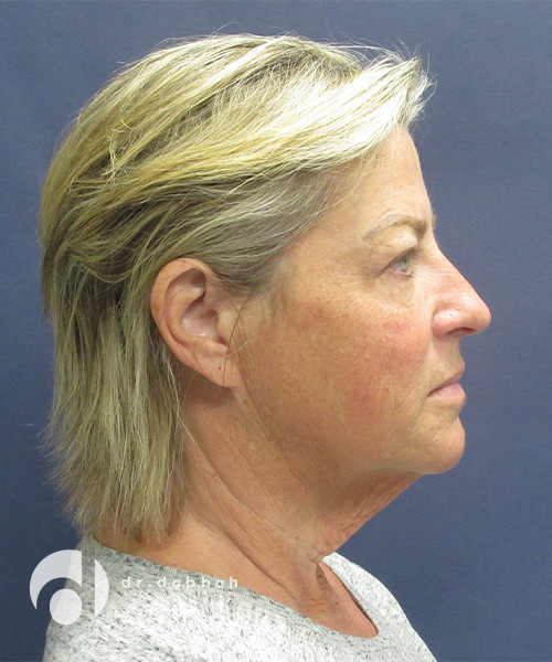 before facelift right side view female patient case 2481