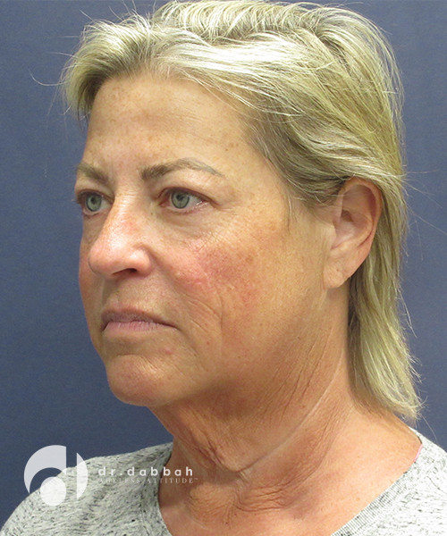 before facelift left view female patient case 2481