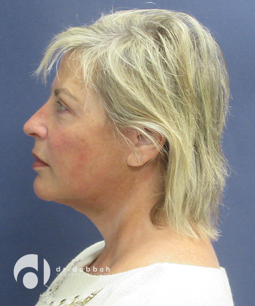 after facelift left side view female patient case 2481