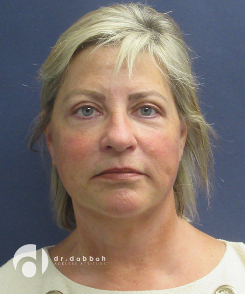 after facelift front view female patient case 2481