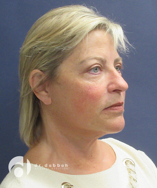 after facelift right view female patient case 2481