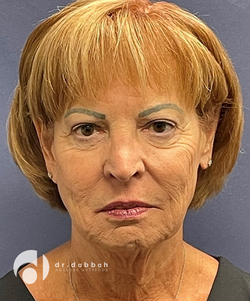 before facelift front view female patient case 2514