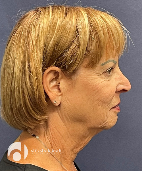 before facelift right side view female patient case 2514