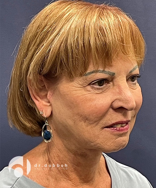 after facelift right angle view female patient case 2514