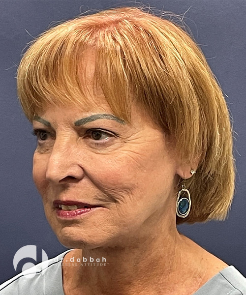 after facelift left angle view female patient case 2514