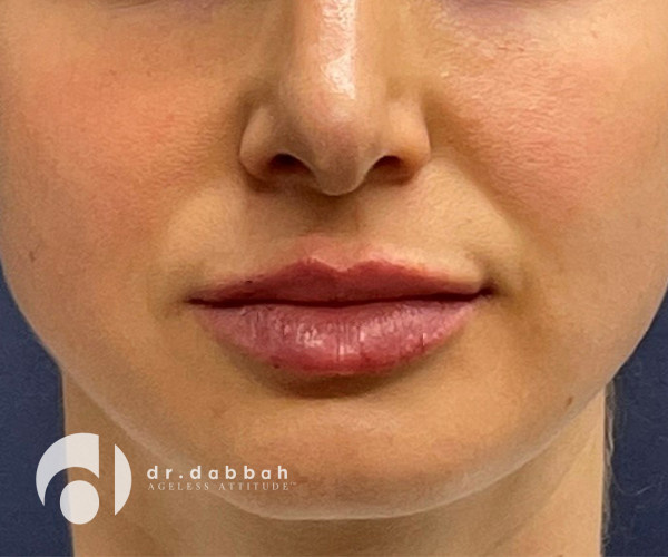 before facial fillers front view female patient case 2409