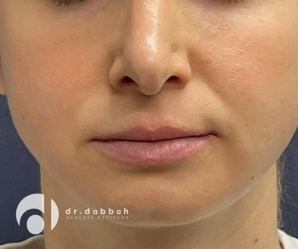before facial fillers front view female patient case 2409