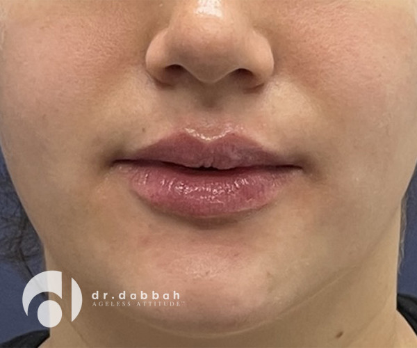 after facial fillers front view female patient case 2412