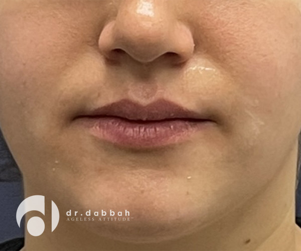 before facial fillers front view female patient case 2412