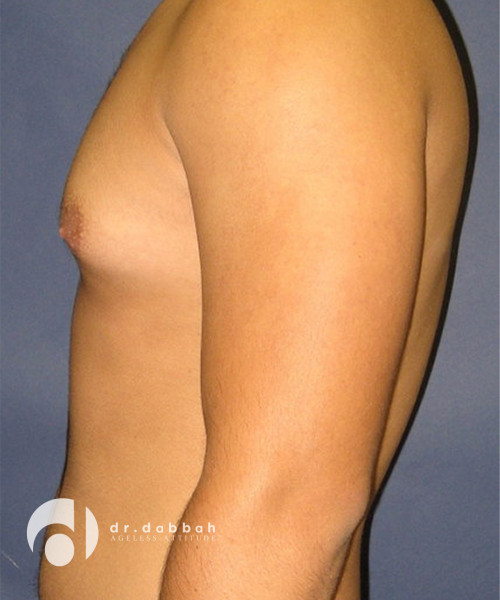 before gynecomastia left side view male patient case 1801
