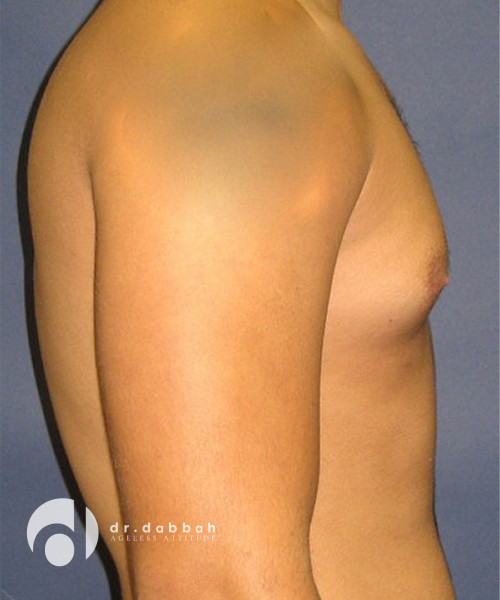before gynecomastia right side view male patient case 1801