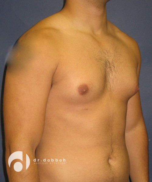 before gynecomastia right view male patient case 1801