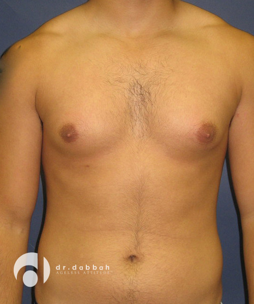 before gynecomastia front view male patient case 1801