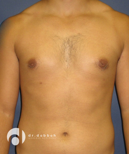 after gynecomastia front view male patient case 1801