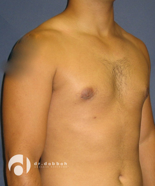 after gynecomastia right view male patient case 1801