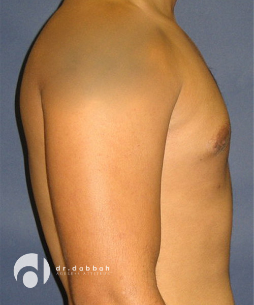 after gynecomastia right side view male patient case 1801