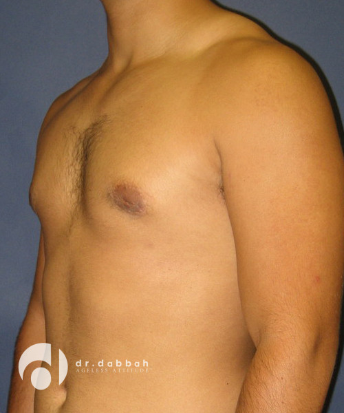 after gynecomastia left view male patient case 1801