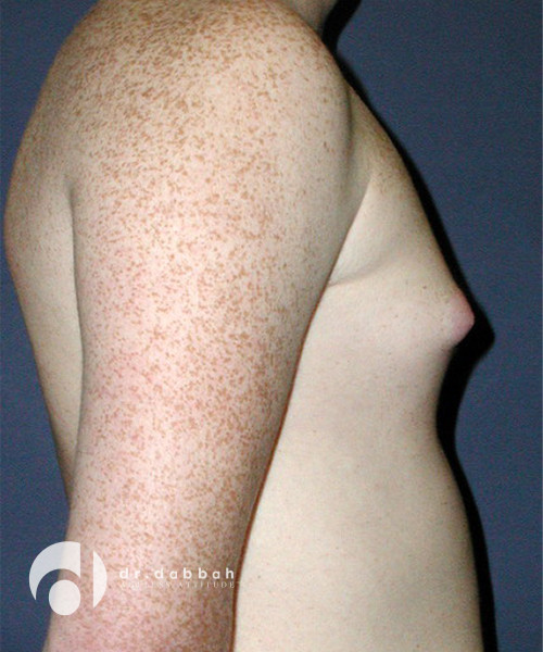before gynecomastia right side view male patient case 1812