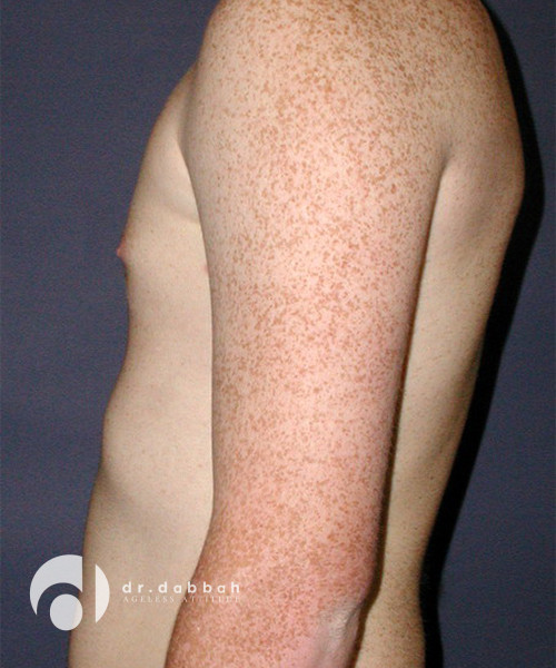 after gynecomastia left side view male patient case 1812